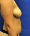 Breast Augmentation case #2658