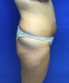 Liposuction case #3690