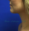 Neck Liposuction case #3821