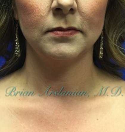 Neck Liposuction case #3821