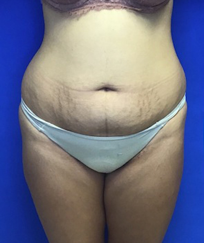 Liposuction case #3690