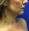 Neck Liposuction case #3821