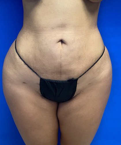 Liposuction case #3690