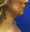 Neck Liposuction case #3821