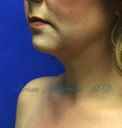 Neck Liposuction case #3821