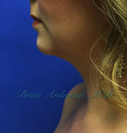 Neck Liposuction case #3821