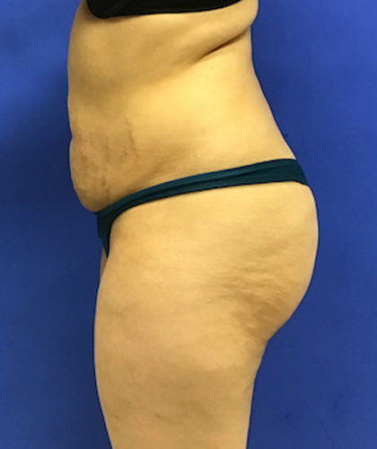 Liposuction case #3700