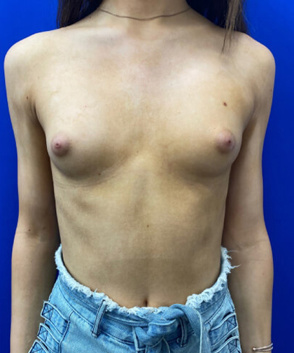 | Arslanian Plastic Surgery Atlanta Before & After Plastic Surgery Results | breast mtf procedure