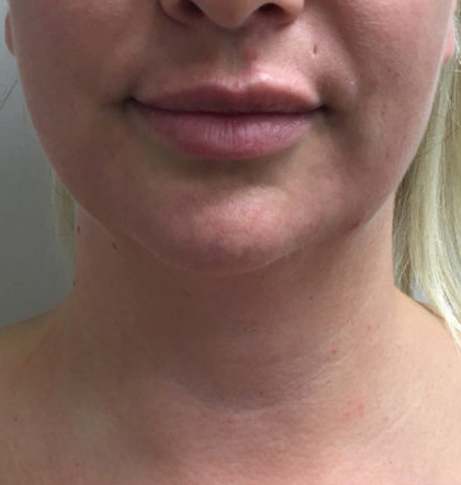 Neck Liposuction case #3853