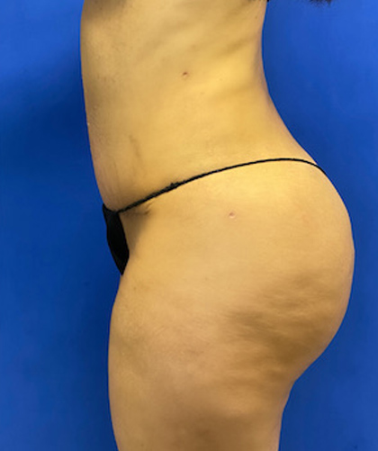 Liposuction case #3700