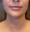 Neck Liposuction case #3853