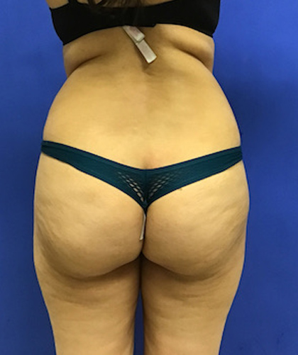 Liposuction case #3700