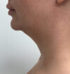 Neck Liposuction case #3853