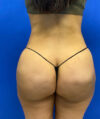 Liposuction case #3700