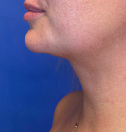 Neck Liposuction case #3853