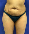 Liposuction case #3700
