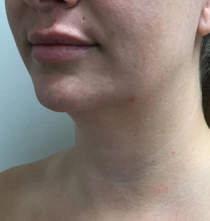 Neck Liposuction case #3853