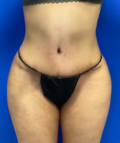 Liposuction case #3700