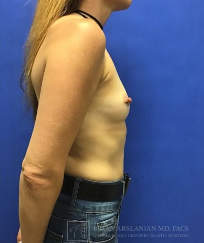 Breast Augmentation case #2669