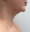 Neck Liposuction case #3853