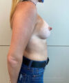 Breast Augmentation case #2669