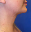 Neck Liposuction case #3853