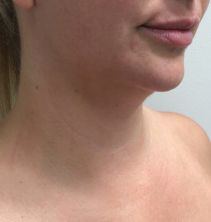 Neck Liposuction case #3853