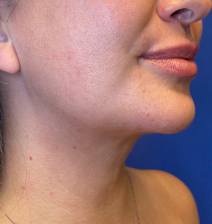 Neck Liposuction case #3853