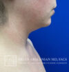 Neck Liposuction case #3865
