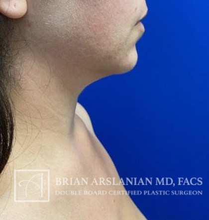 Neck Liposuction case #3865