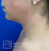 Neck Liposuction case #3865