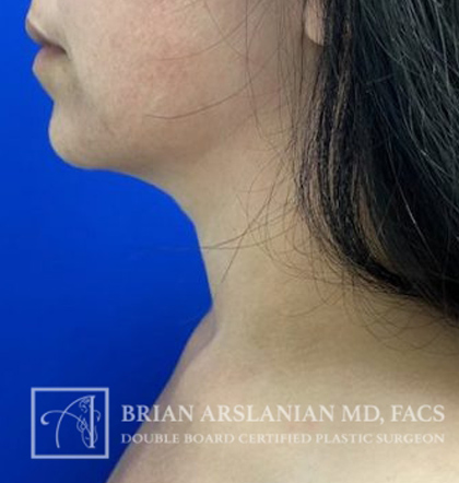 Neck Liposuction case #3865