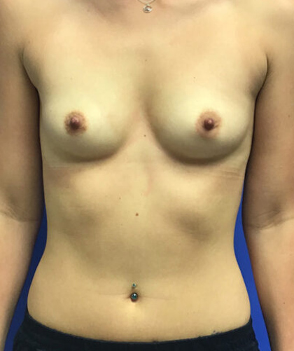 Breast Augmentation case #2691