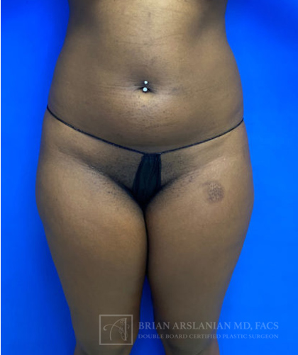 Liposuction case #3707