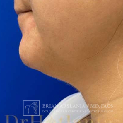 Neck Liposuction case #3870