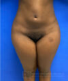 Liposuction case #3707