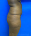 Liposuction case #3707