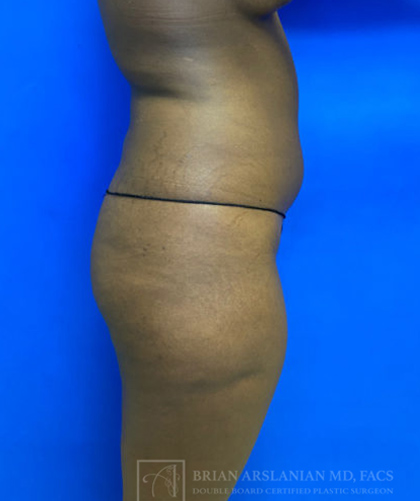 Liposuction case #3707