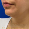 Neck Liposuction case #3870