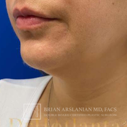 Neck Liposuction case #3870