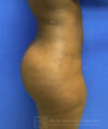 Liposuction case #3707