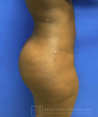 Liposuction case #3707