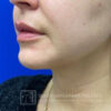 Neck Liposuction case #3870