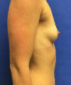 Breast Augmentation case #2691