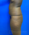 Liposuction case #3707