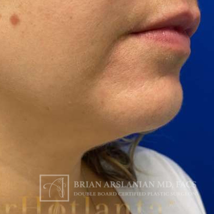 Neck Liposuction case #3870