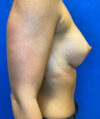 Breast Augmentation case #2691