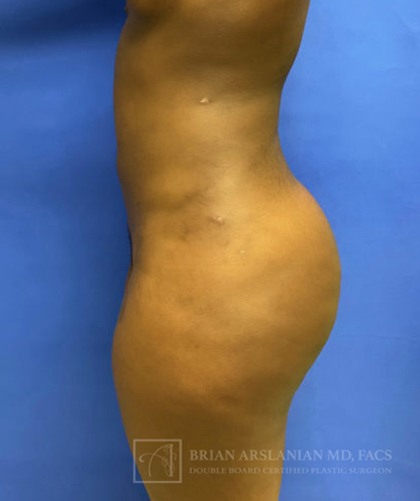 Liposuction case #3707