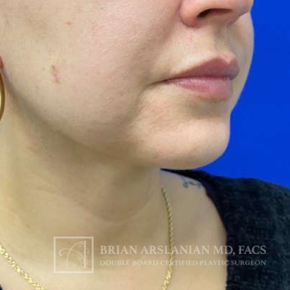 Neck Liposuction case #3870