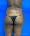 Liposuction case #3707